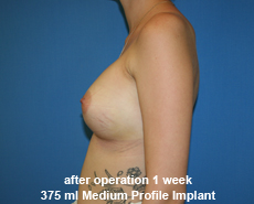 plastic-surgery-breast-augmentation
